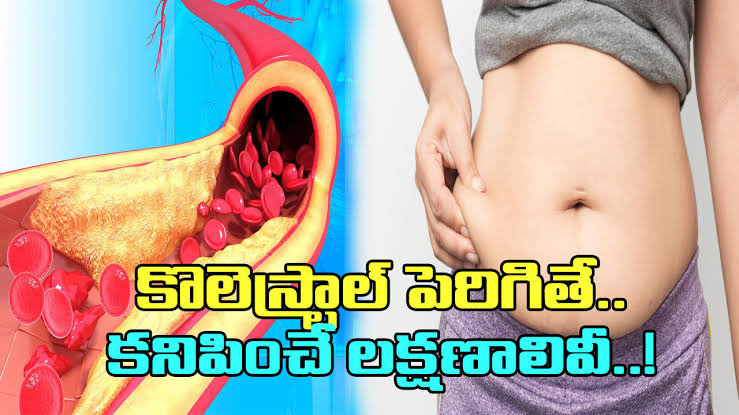 కొలెస్ట్రాల్ పెరిగితే కనిపించే  లక్షణాలు ఇవే..